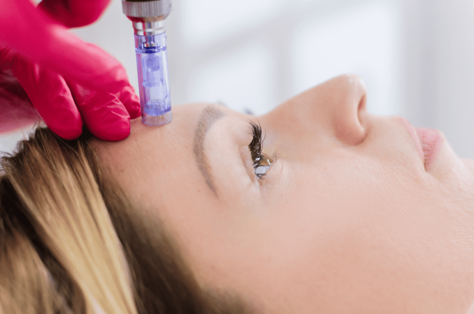 Woman having Collagen Induction Therapy