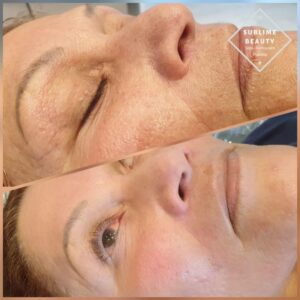 Collagen Induction Therapy, Dermapen, Microneedling before and after