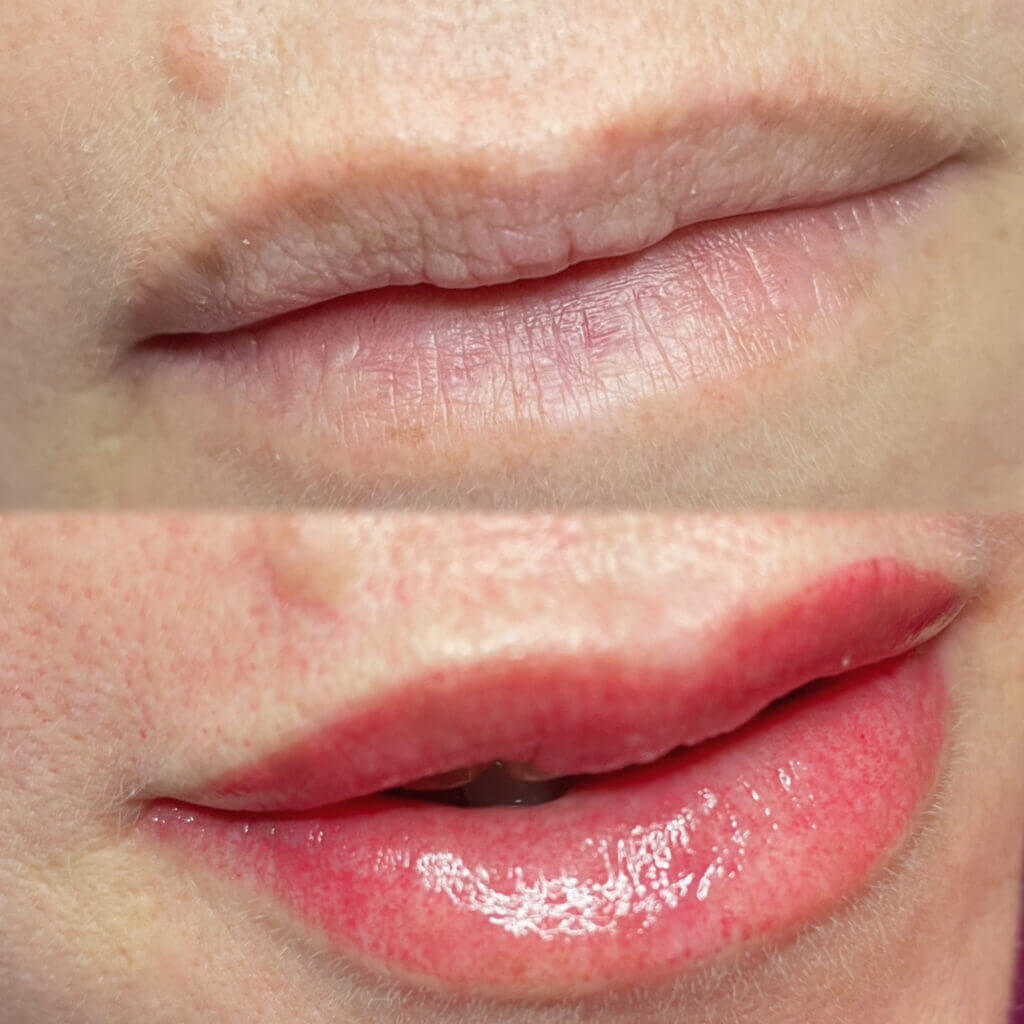 Before and after images displaying the transformative results of lip blush treatment on a woman. The treatment effectively neutralized small patches of brown hues, leaving behind a harmonious and enhanced lip colour.
