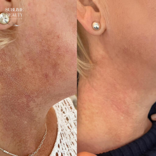 Transformational microneedling results on a woman's neck – the image reveals the disappearance of red blotches and marks, leaving behind clear, smooth, and evenly toned skin after the treatment.
